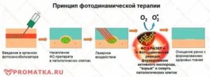 Фотодинамическая терапия при лечении рака шейки матки