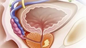 Как лечить фиброз простаты народными средствами