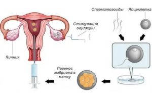 Плохое качество яйцеклеток это бесплодие