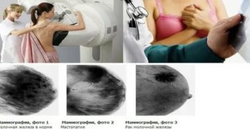 В какой период менструального цикла делать маммографию