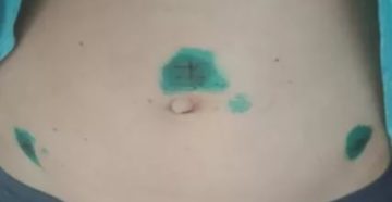 Сколько дней может быть задержка месячных после лапароскопии Сколько дней может быть задержка месячных после лапароскопии