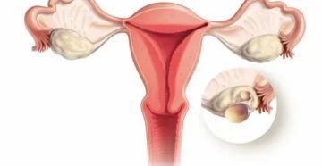 Почему стреляет в яичниках перед месячными Почему стреляет в яичниках перед месячными