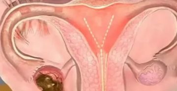 Могут ли быть месячные если не работают яичники