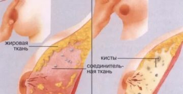 Можно ли при фиброзно кистозной мастопатии делать йодовую сетку