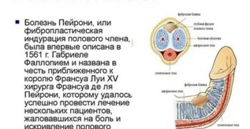 Можно ли вылечить болезнь пейрони без операции