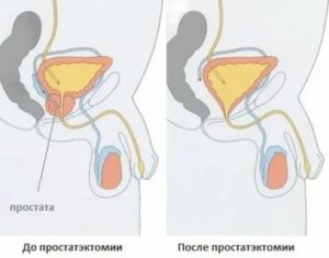 Недержание мочи при удалении рака предстательной железы