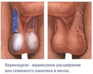 Повреждение семенной канатик бесплодие