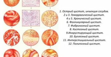 Что такое гематурический цистит