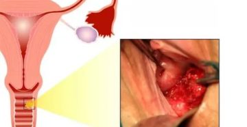 Как проходят месячные при раке шейки матки