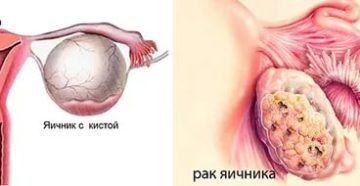 Может ли быть рак яичника у подростков