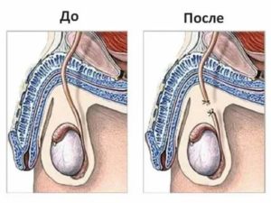 Что делать если после операции варикоцеле увеличилось яичко