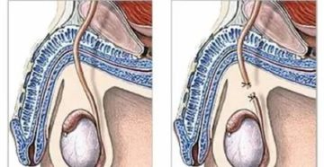 Что делать если после операции варикоцеле увеличилось яичко