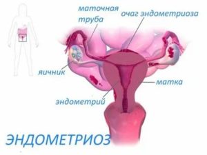 Как уменьшить эндометрий при менопаузе народными средствами