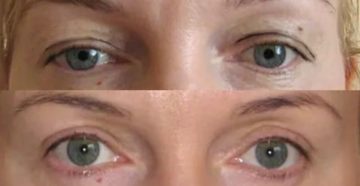 Почему нельзя делать блефаропластику во время месячных Почему нельзя делать блефаропластику во время месячных