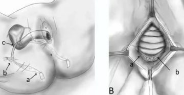 Что такое пластическая операция при выпадении матки