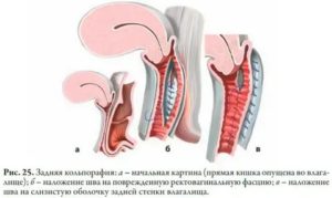 Как делается операция по сужению влагалища