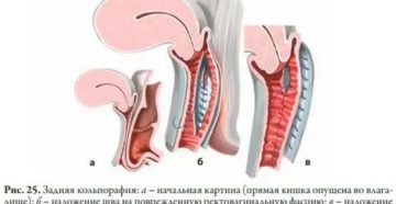 Как делается операция по сужению влагалища