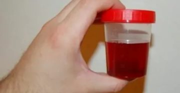 Что если прошли месячные а моча с красным цветом Что если прошли месячные а моча с красным цветом