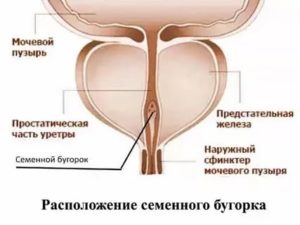 Киста семенного бугорка предстательной железы