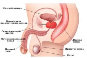 Можно ли при хроническом простатите заниматься оральным сексом