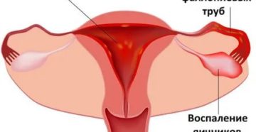 Чем лечить воспаление придатков во время месячных Чем лечить воспаление придатков во время месячных