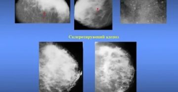 Диффузно узловая гиперплазия железы. Узловая фиброзно-кистозная мастопатия. Узловая форма ФКМ молочной железы маммография. Фиброзно-кистозная мастопатия молочных желез на маммографии. Диффузная мастопатия маммография.