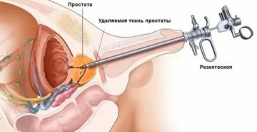 Озонотерапия при лечении аденомы простаты
