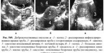 Доброкачественная опухоль в маточной трубе