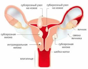 Почему может быть увеличена матка у женщины перед месячными