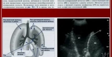 Плеврит легких при раке молочной железы прогноз