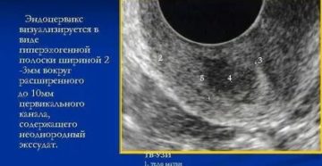 Что такое эндоцервикс в гинекологии на узи