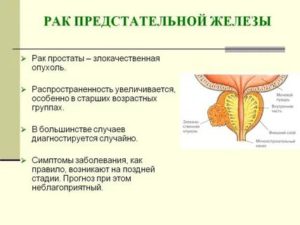 Причины психологические возникновения рака предстательной железы