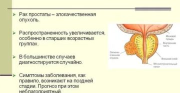 Причины психологические возникновения рака предстательной железы