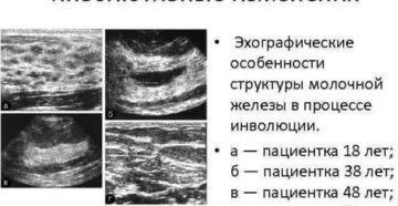 Инволютивные изменения молочной железы на узи