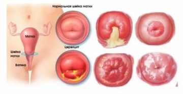 Что такое уреаплазменный цервицит