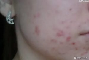 Могут ли от вич быть прыщики на лице