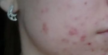 Могут ли от вич быть прыщики на лице