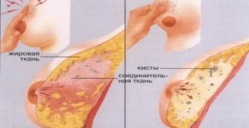 Могут ли перед месячными появляться уплотнения на груди Могут ли перед месячными появляться уплотнения на груди