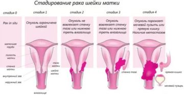 Как убрать опухоль с влагалища