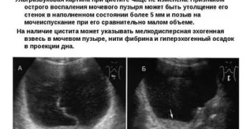 Можно ли делать узи мочевого пузыря при цистите у