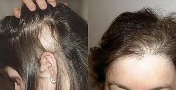 Почему нет месячных по 2 месяца и выпадают волосы