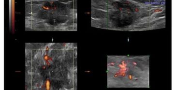 Узи с контрастным веществом молочных желез