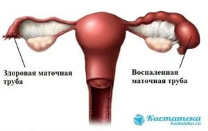 Почему образовывается в маточных трубах кисты