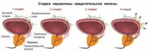 Рак простаты у мужчин симптомы лечение 3 степени что нужно сделать чтобы