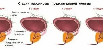 Рак простаты у мужчин симптомы лечение 3 степени что нужно сделать чтобы