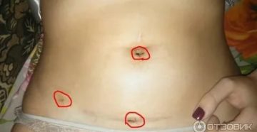 Почему после лапароскопии месячные болезненные