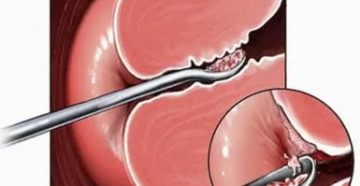 Сколько идут месячные после чистки гиперплазии эндометрия Сколько идут месячные после чистки гиперплазии эндометрия