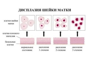 Как лечить дисплазию шейки матки 2 степени без операции