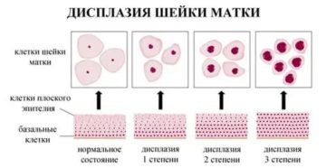 Как лечить дисплазию шейки матки 2 степени без операции