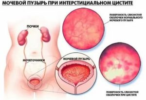 Когда при цистите делают цистоскопию
